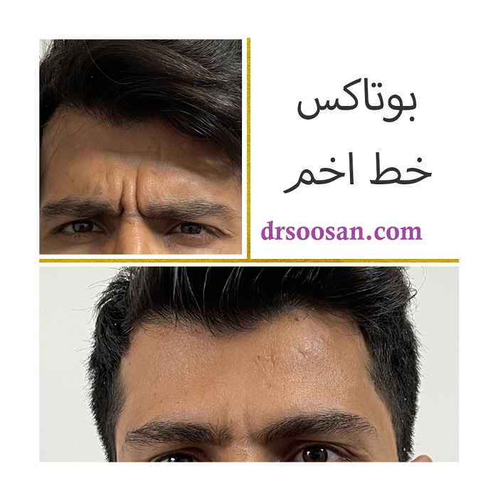 رفع خطوط اخم